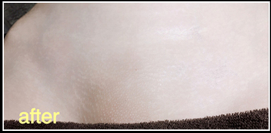 WAX脱毛モニター様Vライン施術後